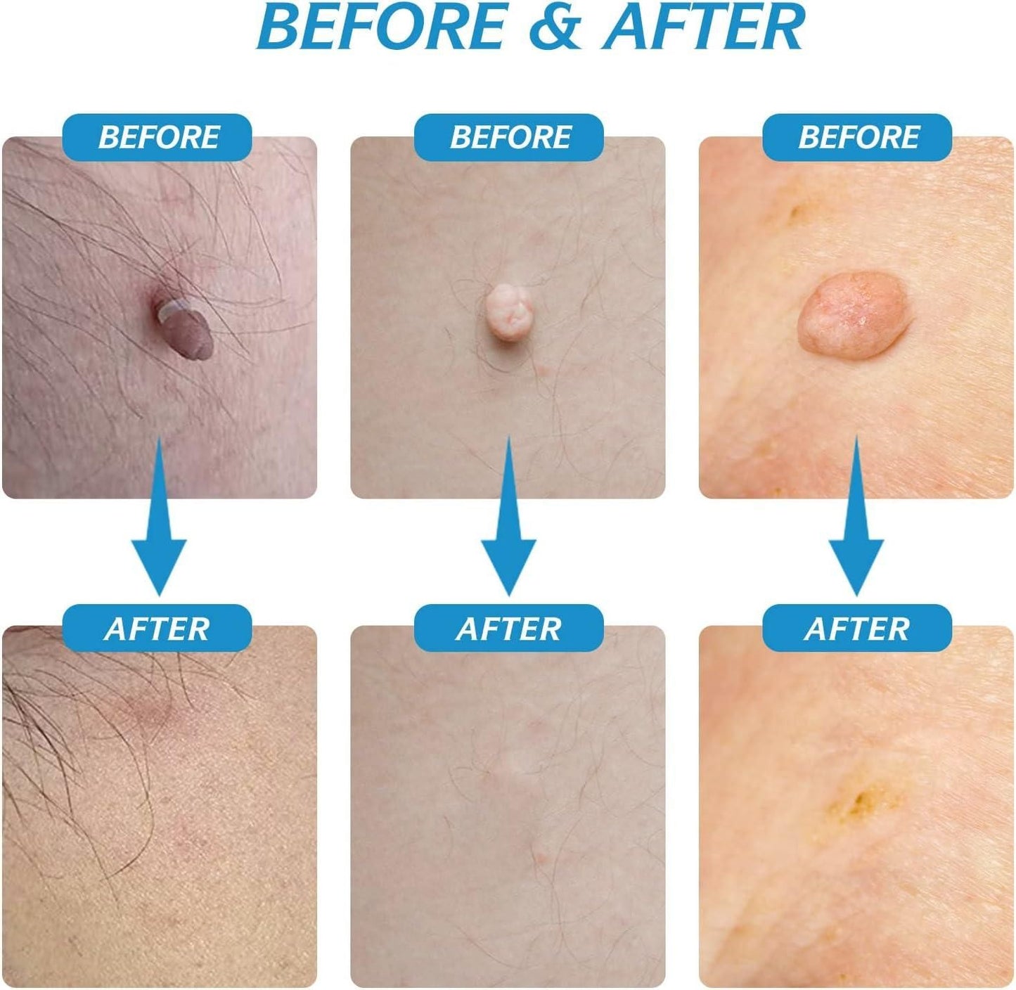 2 in 1 Skin Tag Remover Kit - Painless